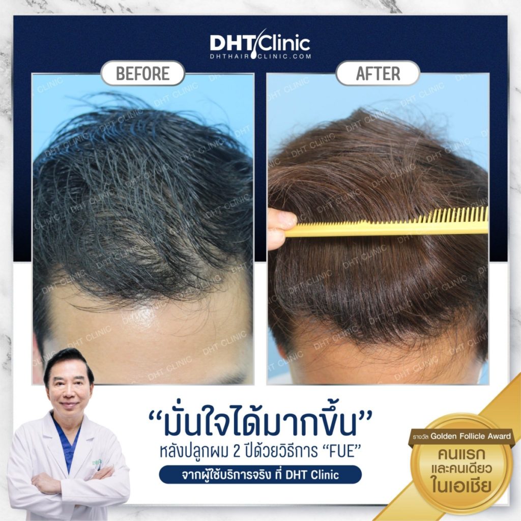 Dhtclinic The First Hair Transplantation Clinic In Thailand 7227