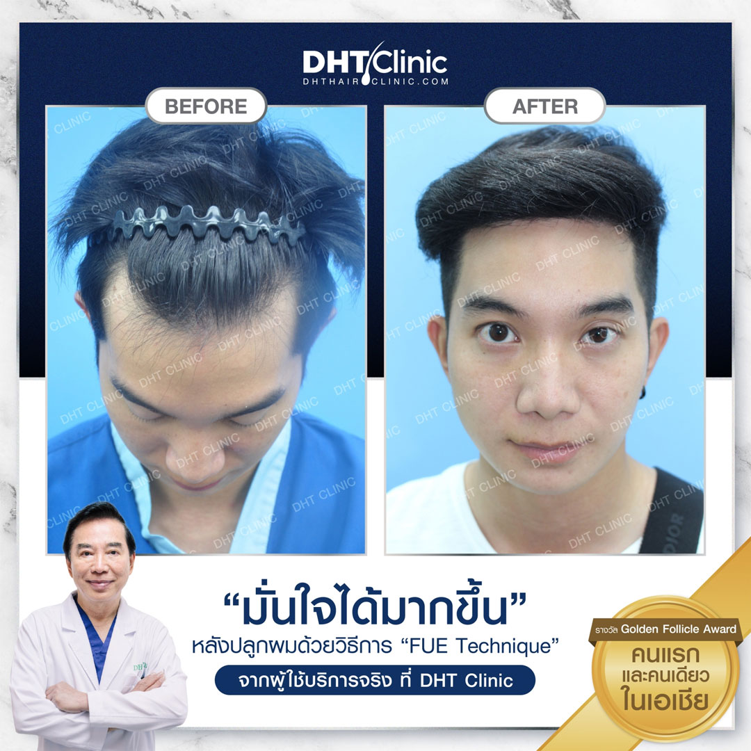 DHTClinic – The First Hair Transplantation Clinic in Thailand
