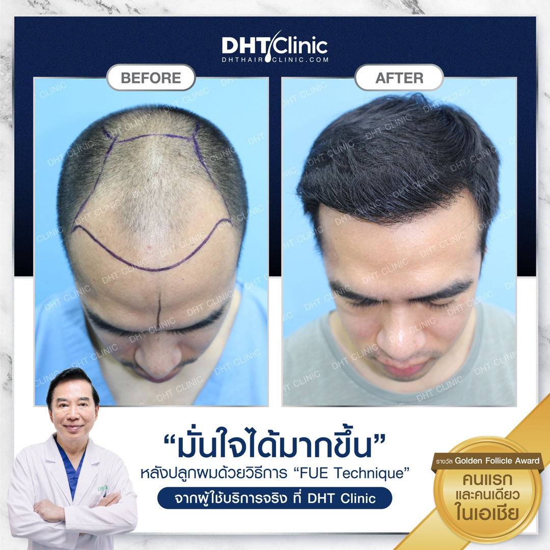 DHTClinic – The First Hair Transplantation Clinic in Thailand