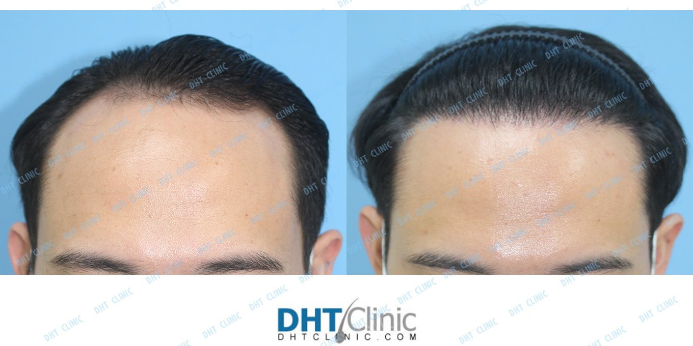 FUE 2,290 grafts to the frontal hairline in an Asian Male
