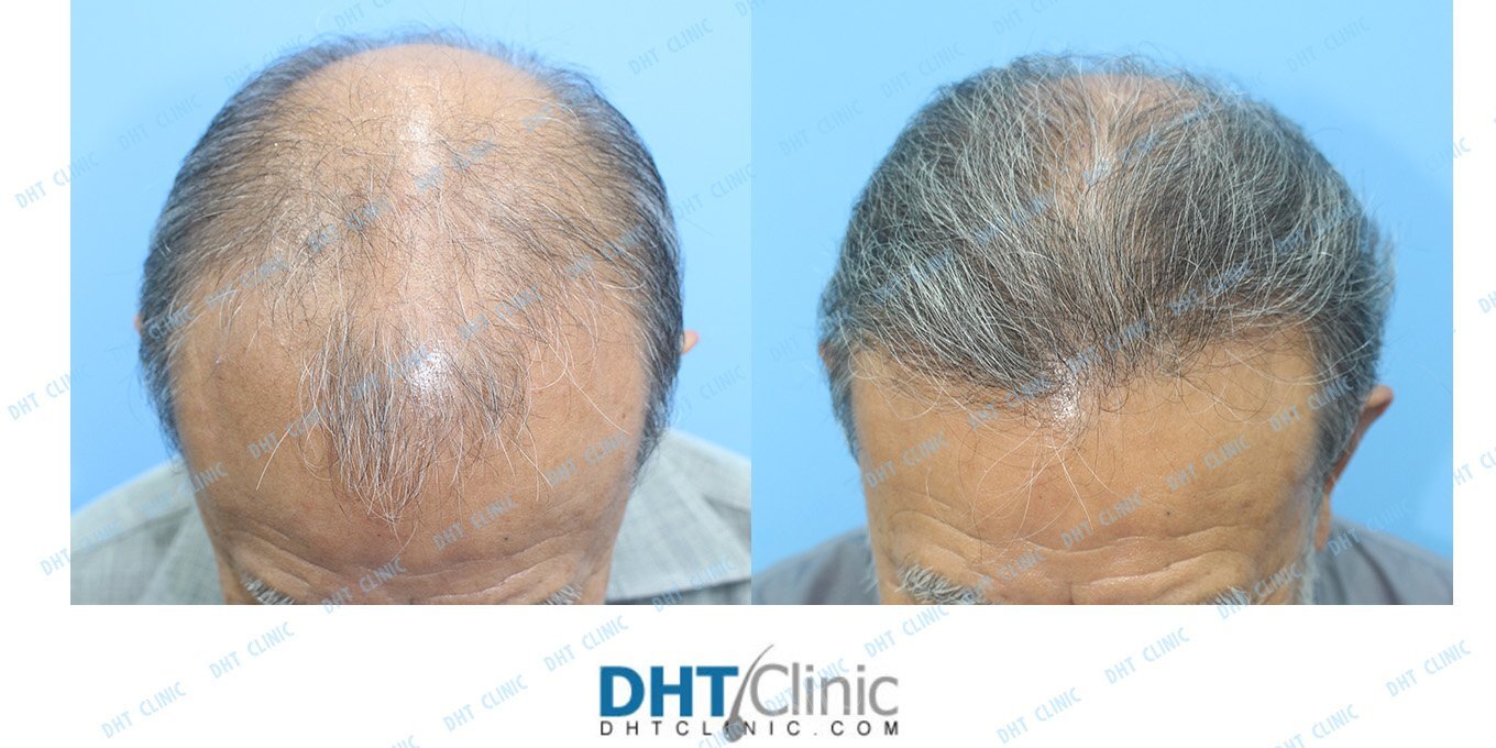 Restoration of frontal hairline in 73 years old / Combo 2,955 grafts / post-op 7 months