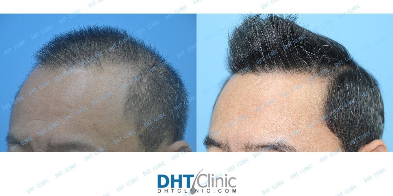 A combination of FUE and FUT with a total of 4,621 grafts in Asian, male