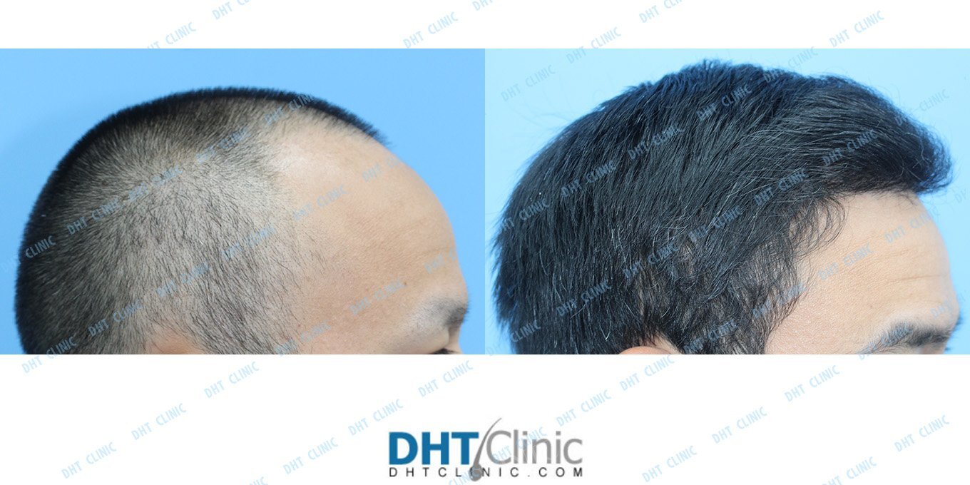 Restoration of frontal hairline and temple/ FUE 2,484 grafts / post-op 5 months