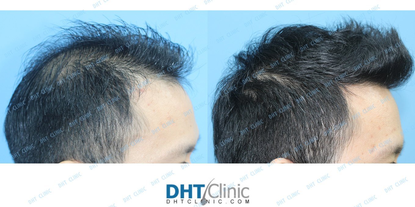 Restoration of frontal hairline and crown/ Combo 3137 grafts (2588 FUT and 594 FUE)