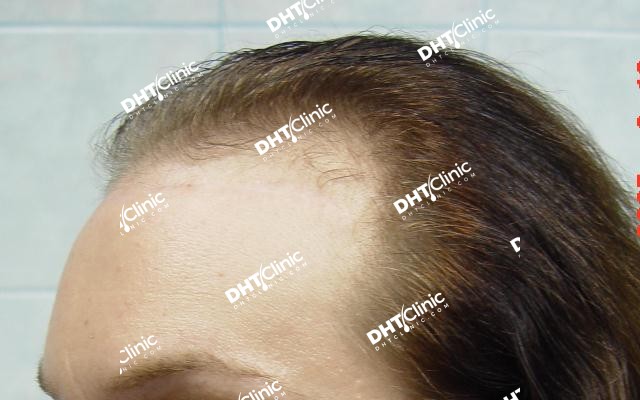 FUT/Feminine hair line 6,185 grafts 6 years post-op