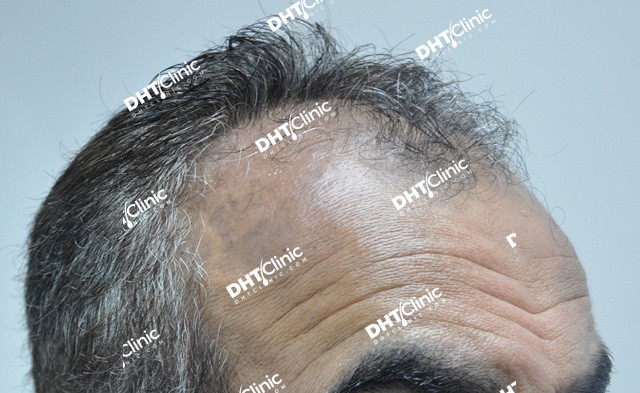 3,880 grafts Combo  1 year 8 Months post-op