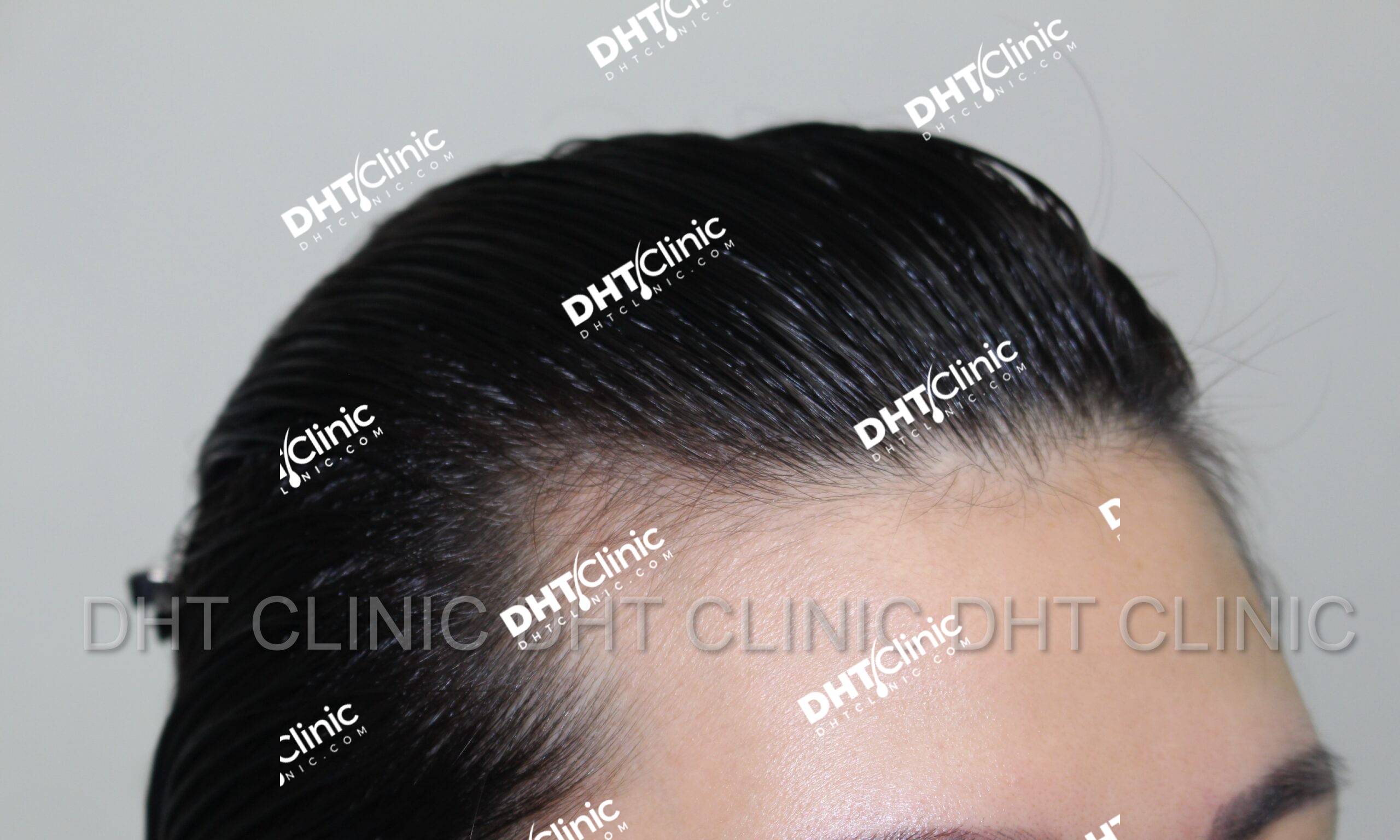 FUT 1125 grafts female hairline