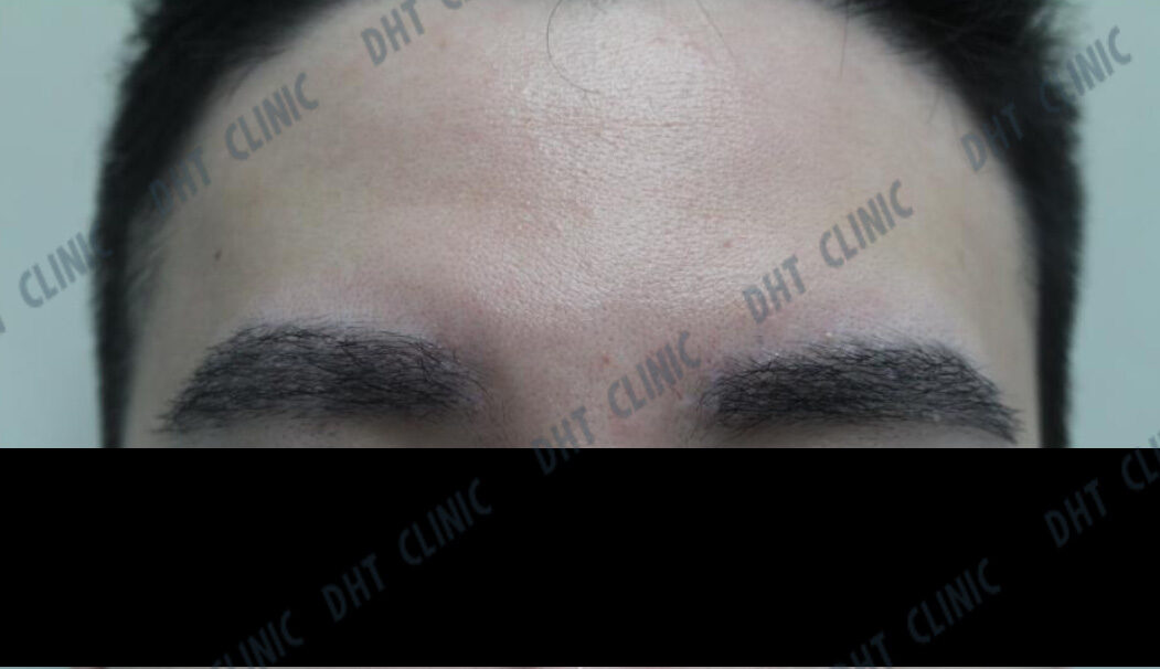 Eyebrow Hair Transplant-Male / POST OP 7 DAYS
