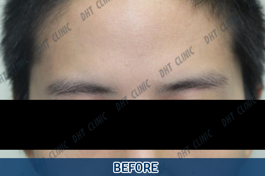 Eyebrow Hair Transplant-Male / POST OP 1 DAY
