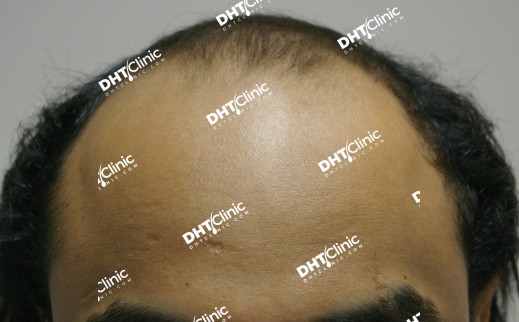 Middle Eastern patient, Total 1971 grafts, Good results in 12 months
