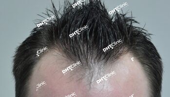 FUE/ 1,442 Grafts/ 18 Months after surgery with good result.