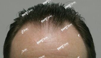 2,784 grafts in 1 session/1 year 7 months post-op