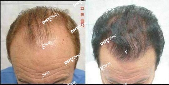 70 years old 7,855 grafts 