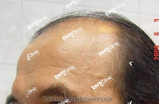 The 62 years old male with NW class VII after hair transplantation 2,725 FUG