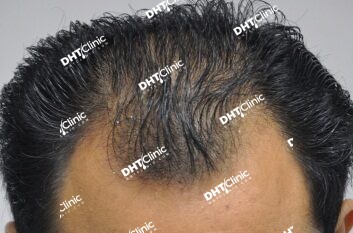 2488 grafts for receding hairline in Asian male