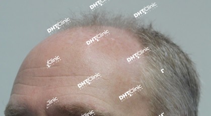 FUE  1 Sessions 2,047 grafts 6 months post-op