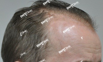 FUE / 1,543 Grafts / 14 months post op results