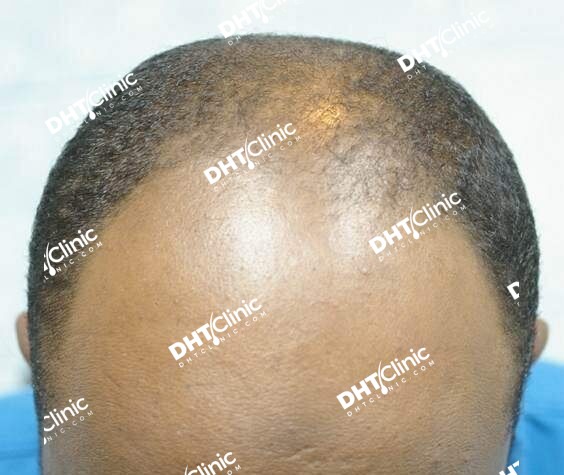 40 years african after one sessions 4,308 grafts