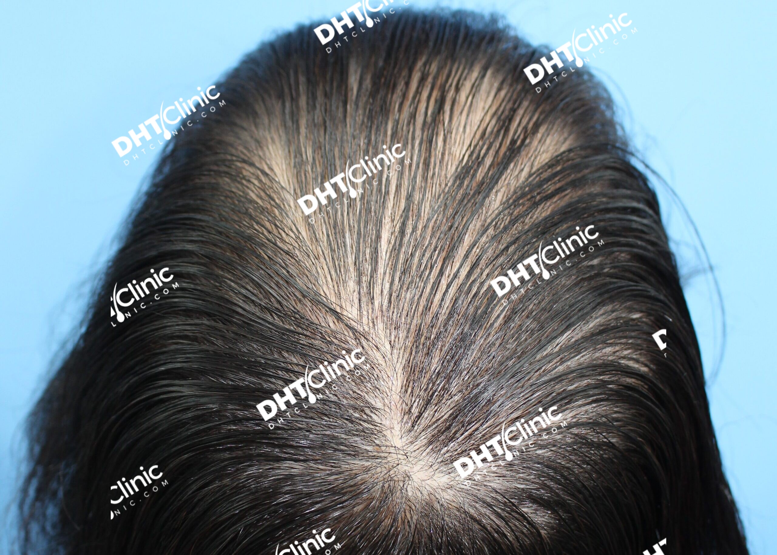 FUT 2198 grafts female hairline