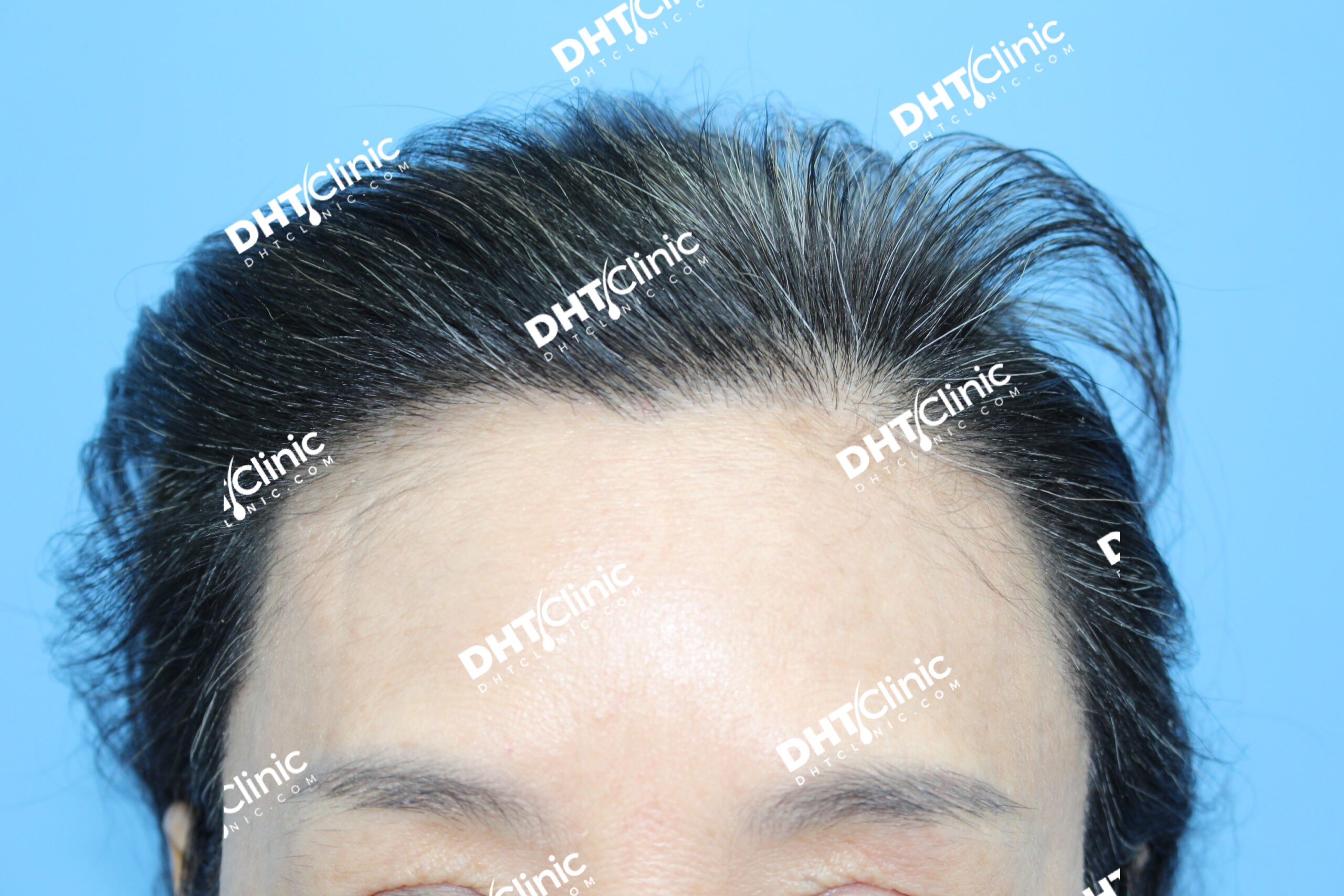 FUT 2259 grafts female hairline