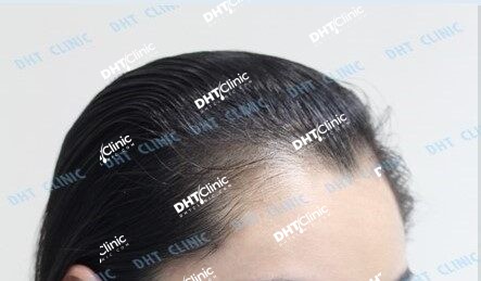 6 FUT-I 1801 grafts, FUT-II 755 grafts female hairline