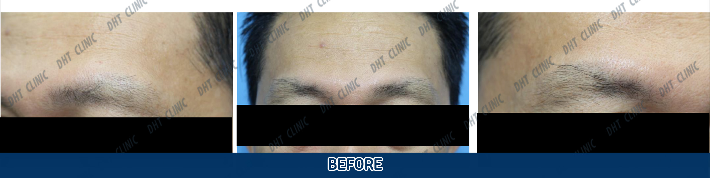 Eyebrow Hair Transplant / Immediately after transplant