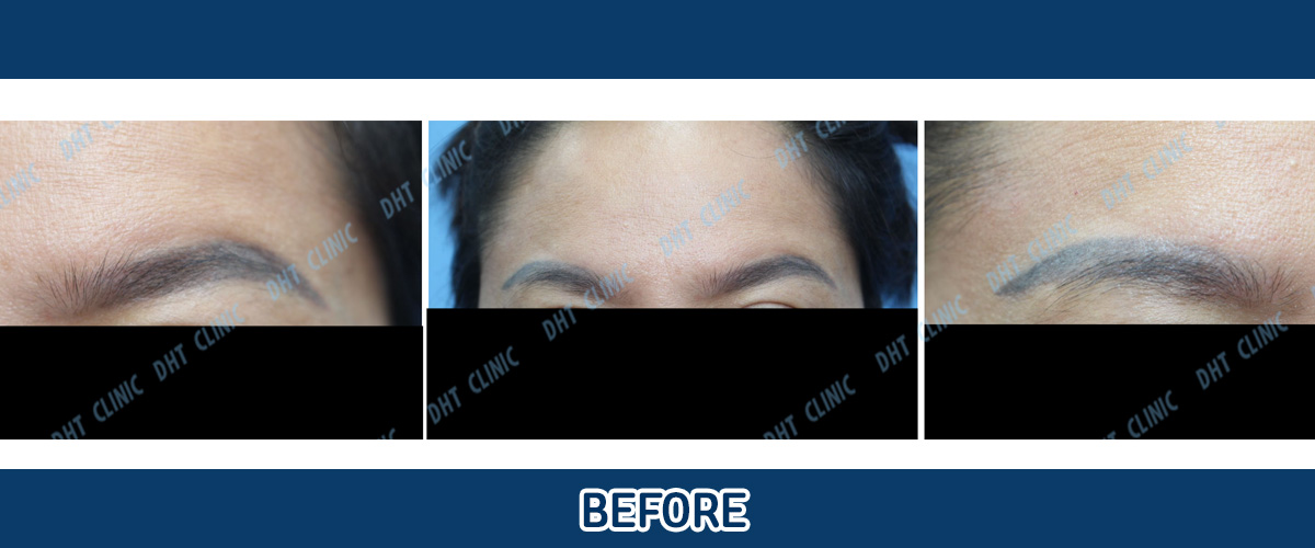 Eyebrow Hair Transplant Female / Immediately after transplant