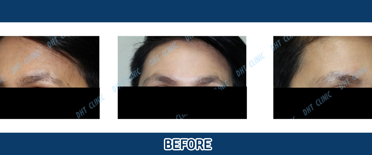 Eyebrow Hair Transplant Female / PO 8 months
