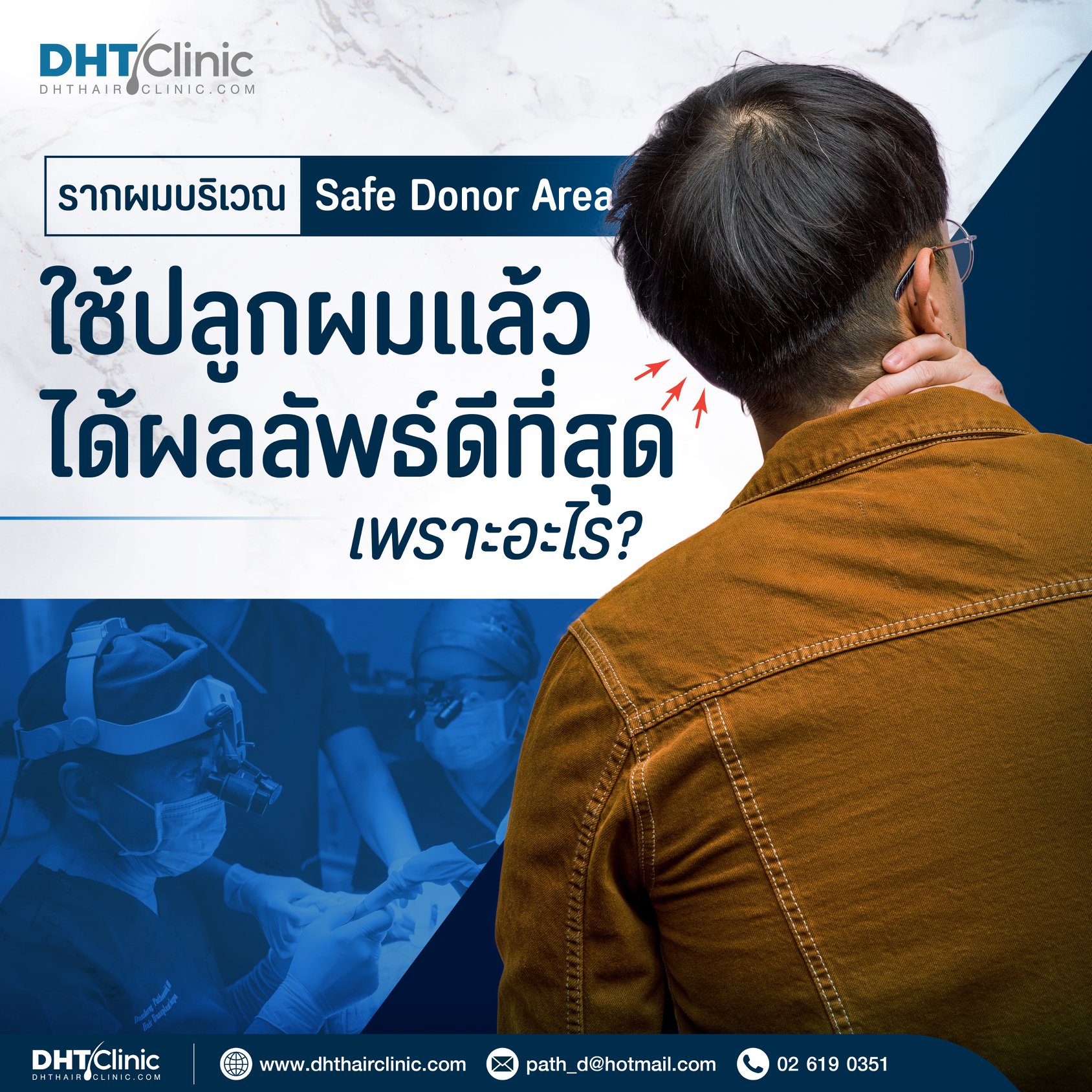 เพราะอะไรรากผมบริเวณ Safe Donor Area ถึงปลูกผมแล้วได้ผลลัพธ์ดีที่สุด ?