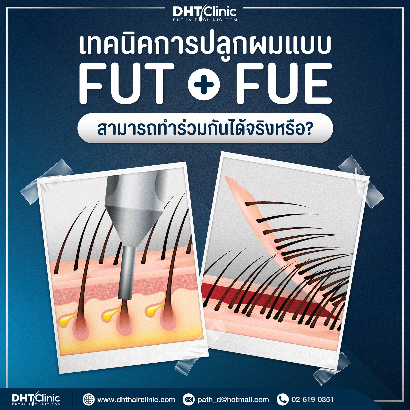 เทคนิคการปลูกแบบ FUT + FUE สามารถทำร่วมกันได้จริงหรือ ?